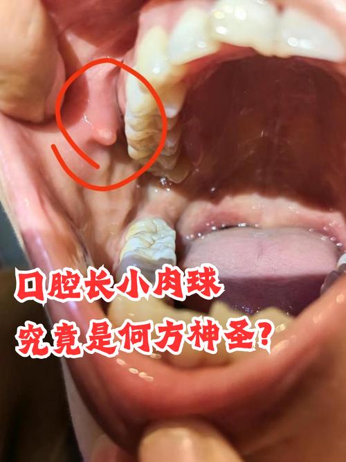 口腔卡波氏肉瘤图片的简单介绍